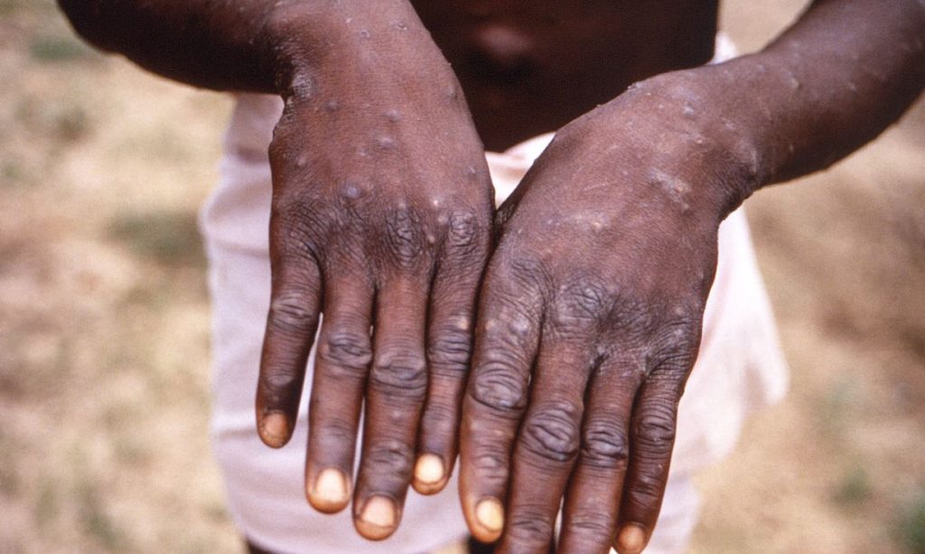 Moradora de Dionísio Cerqueira está internada com suspeita de Monkeypox
